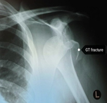 AP X-ray of acute shoulder dislocation with an associated fracture of the greater trochanter.