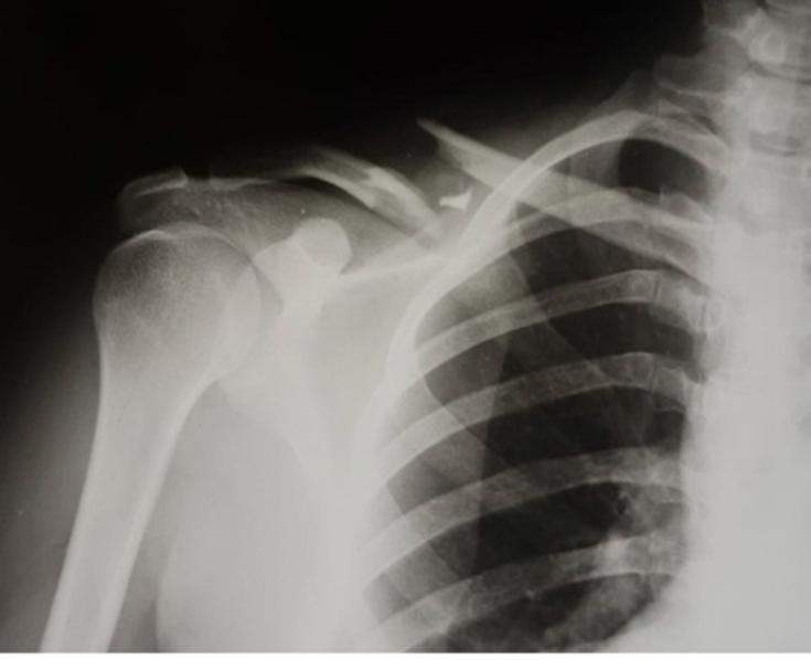 X-Ray showing a midshaft clavicle fracture with 100% displacement and shortening.