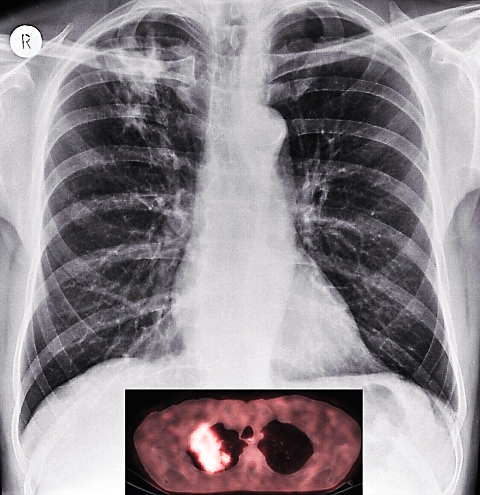 PET CT image of pulmonary TB