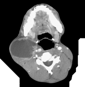 Figure 2: Fitting of WBAN on patient