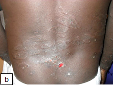 Pityriasis Rosea Treatment & Prevention l Water's Edge Dermatology