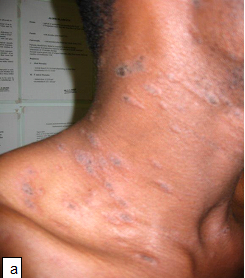 Pityriasis Rosea Treatment & Prevention l Water's Edge Dermatology